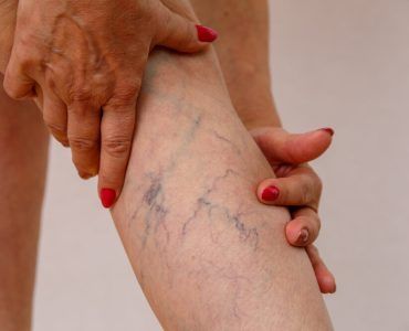 Natural Remedies for Spider Veins