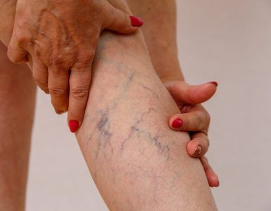 Natural Remedies for Spider Veins